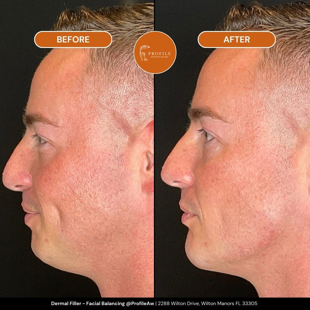 Dermal Filler - Facial Balancing Before and After Profile Med Spa Fort Lauderdale