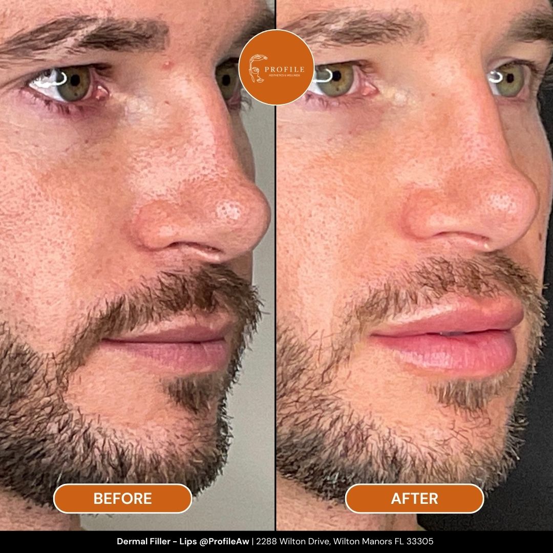Dermal Filler - Lips 1 Before and After Profile Med Spa Fort Lauderdale