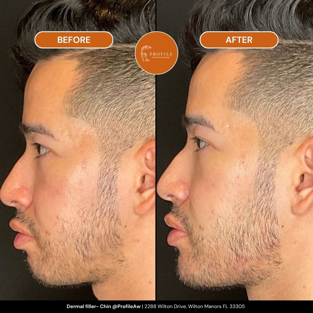 Dermal filler- Chin Before and After Profile Med Spa Fort Lauderdale