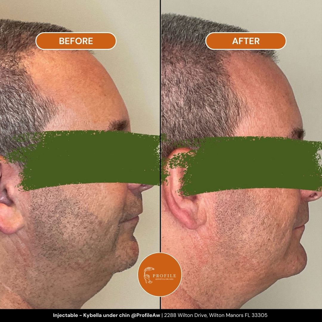 Injectable - Kybella under chin Before and After Profile Med Spa Fort Lauderdale