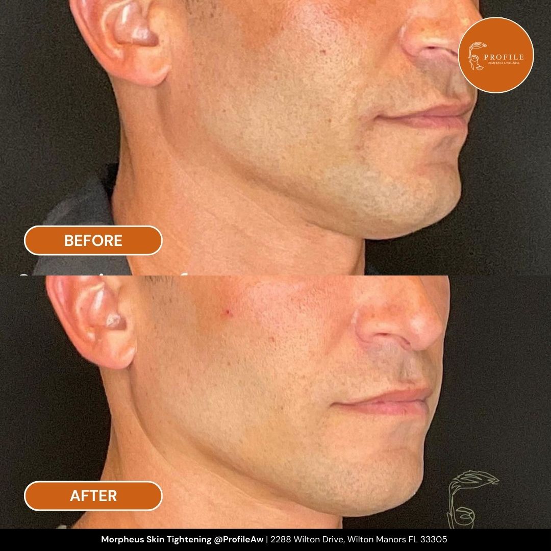 Morpheus Skin Tightening face Before and After Profile Med Spa Fort Lauderdale