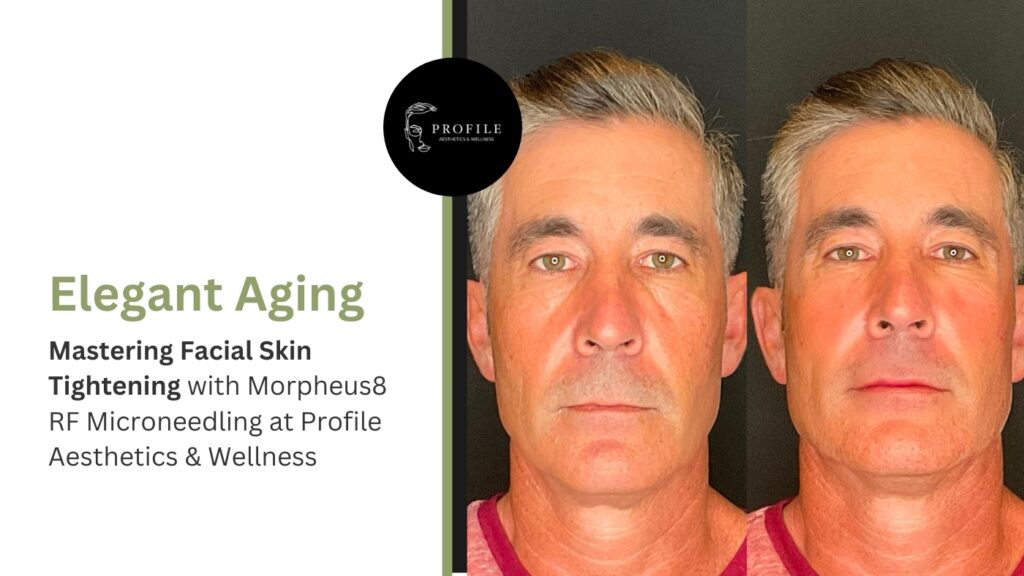 facial skin tightening before and after patient